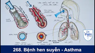 #268. Bệnh hen suyễn (Asthma) và cách chữa trị