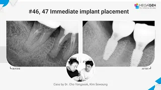 Dr. Yongseok CHO, Sewoung KIM, #46, 47 Immediate implant surgery and prosthesis