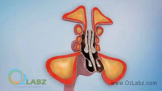 Sinusitis Animation