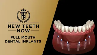 Full Mouth Dental Implant Procedure