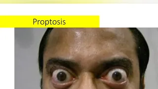 Proptosis | etiology, type and work up protocol |