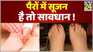 Sanjeevani:डॉ. प्रताप चौहान से जानिए बार-बार पैरों में सूजन आना सेहत के लिए कितना खतरनाक हो सकता है?