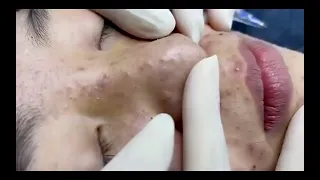 2 RELAXING BLACKHEAD | WHITEHEAD REMOVAL SPA VIDEOS | NOSE | SATISFY EVERYDAY