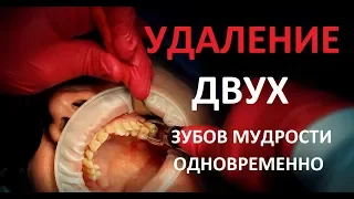 Удаление 2 зубов мудрости одновременно