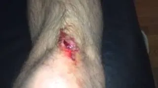 Knee cut