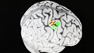 Miami Project Researchers Show First Evidence of Using Cortical Targets to Improve Motor Function