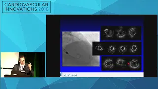 CVI2018 Session: Abrupt  vessel closure - Thomas Todoran, MD