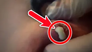 Most Satisfying Pimple Popping Moments 2020 - Part 5