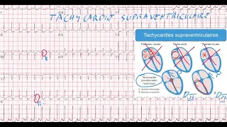 20 ECG - Quiz - Dr Synapse