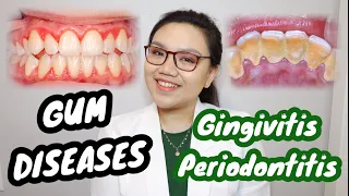 GUM DISEASE: Gingivitis and Periodontitis 🦷 Namamagang gilagid, masama ba? | Dr. Bianca Beley