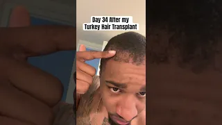 Day 34 of my Turkey Hair Transplant