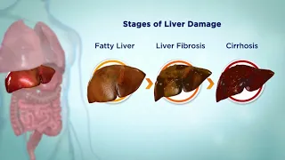 Hepatitis C (HCV ): Causes, symptoms, Diagnosis & Treatment options