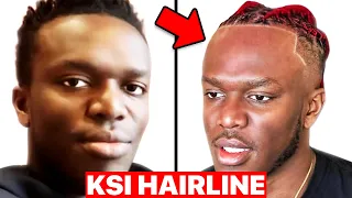 Hair Surgeon Reacts to KSI Hairline