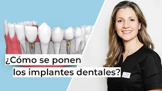 ¿Cómo se ponen los implantes dentales paso a paso? | Clínica dental en Alcobendas Avodent