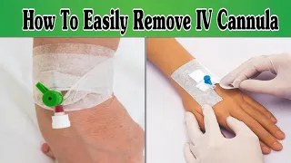 IV Cannula Removal Procedure : Tips and Tricks