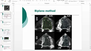 Assessment of LV by echocardiography, Dr  Wael Elkilany