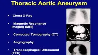Minimally Invasive Repair of Thoracic Aortic Aneurysm Video - Brigham and Women's Hospital