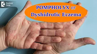 DYSHIDROTIC ECZEMA OR POMPHOLYX: Causes,Symptoms, & Treatment - Dr. Aruna Prasad | Doctors' Circle