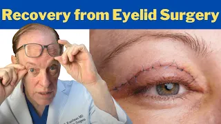 How to Recover from a Blepharoplasty | Plastic Surgeon's Guidance on Eyelid Surgery Recovery