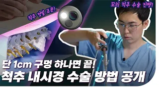 작은 상처, 적은 손상으로 정확한 척추 수술을! 단일공 내시경 수술 [척추톡 3화]