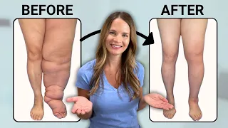 The Best Treatment for Lymphedema!