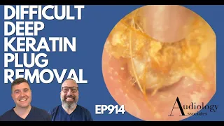 DIFFICULT DEEP KERATIN PLUG REMOVAL - EP914