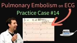 ECG Findings in Pulmonary Embolism - EKG Changes With an Acute PE