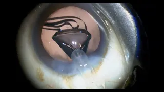Plus1 EMV | RayOne EMV Intraocular lens implantation with cataract surgery by Dr. Michael George