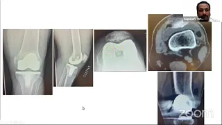 "Know your Plastic" in Knee Replacement