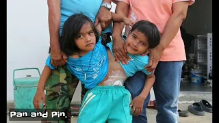 8 Conjoined Twins You Need To See To Believe