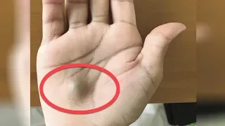 A Man Found This Strange Lump On His Palm  Then A Scan Revealed The True Cause Of His Pain