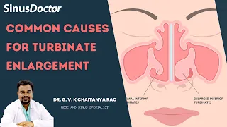 Causes for turbinate enlargement