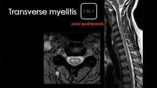 Imaging of Spinal infection   Prof  Dr  Mamdouh Mahfouz 720p