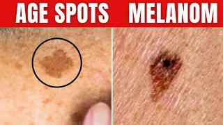 Do You Have Age Skin Spots or Skin Cancer? This is How You Will Know...