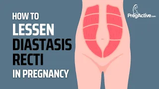 How to Reduce Diastasis Recti During Pregnancy