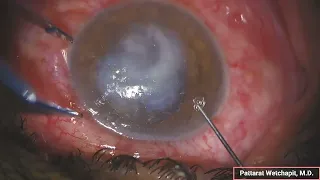 Intrastromal Amphotericin B injection in severe fungal corneal ulcer