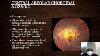 DEGENERATIONS,ANAMOLIES,TUMORS OF UVEA 1 video