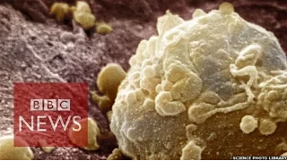 Cancer Breakthrough: Drug mix 'shrinks 60% of melanomas' - BBC News
