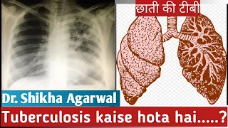 Tuberculosis /TB symptoms/  Pulmonary Tuberculosis/छाती की टीबी/Drshikha Agarwal