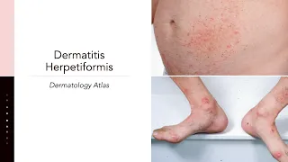 Dermatitis Herpetiformis