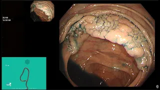 EMR OF LARGE CAECAL LST-G