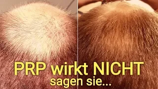 Hilft eine PRP Behandlung ? DAS Mittel gegen Haarausfall !!!🌱