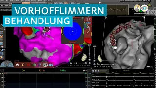 Behandlung von Vorhofflimmern künftig ohne gefährliche Nebenwirkungen möglich