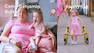 La única persona en el mundo con la enfermedad de Benjamin Button | Soy increíble