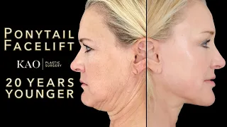 20 Years Younger with Plastic Surgery? Dr. Kao Ponytail Facelift™ Before And After