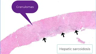 Primary biliary cholangitis (PBC): differential diagnoses