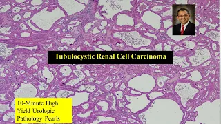Tubulocystic Renal Cell Carcinoma