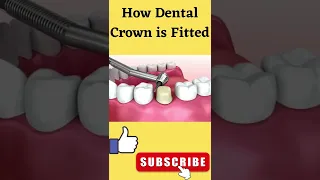 दांत पर कैप कैसे लगाई जाती है? | How Dental Crown is Fitted #Shorts