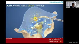 Basivertebral Nerve Ablation For Low Back Pain | Regenerative Treatments for Spine Conditions