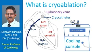 What is cryoablation?